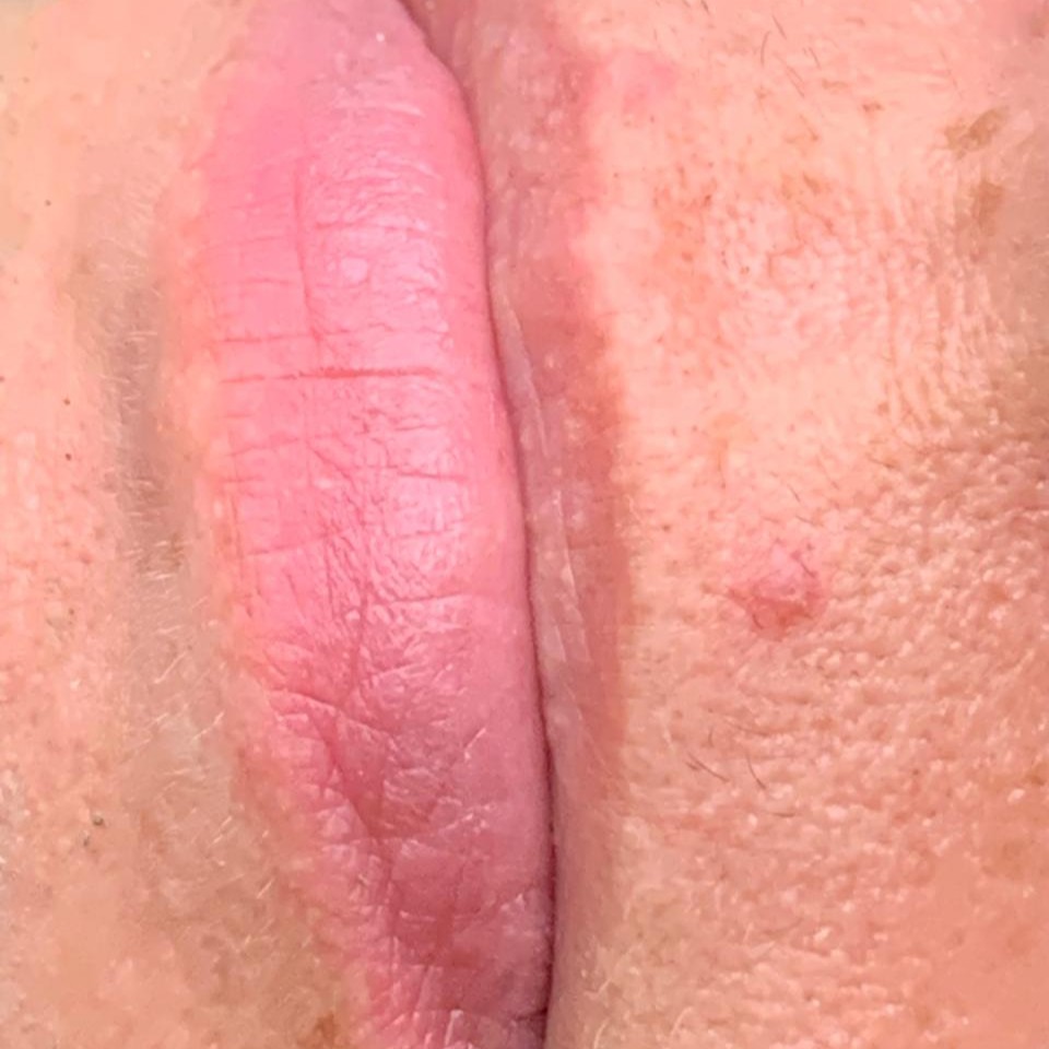 Antes — Hydragloss Labial